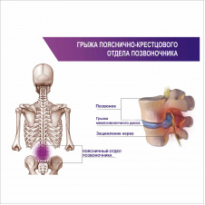 Плакат Грижа попереково-крижового відділу хребта А1