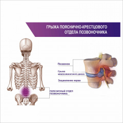 Плакат Грижа попереково-крижового відділу хребта А1 Конотоп