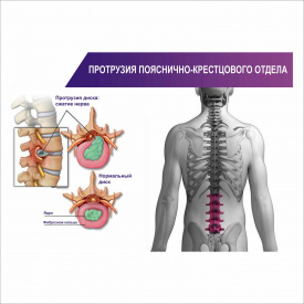 Плакат Vivay “Протрузия пояснично-крестцового отдела” А0
