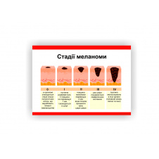 Плакат Vivay Стадії меланоми 30 х 40 см Білий