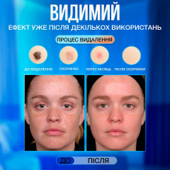 Електрокоагулятор плазмовий VLVEE Білий (VLV-5163) Дніпро