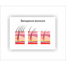 Плакат Vivay Выпадение волос 30х40 см Белый
