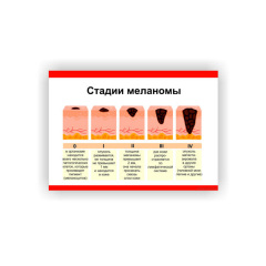 Плакат Vivay Стадії меланоми 30 х 40 см Білий Охтирка