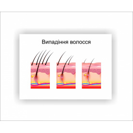 Плакат Vivay Випадіння волосся 30х40 см Білий